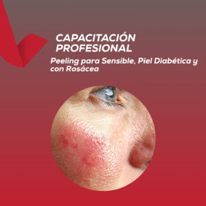 <strong> Peeling para Piel Sensible, Piel Diabética y con Rosácea </strong>